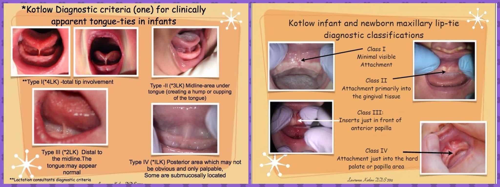 lip tie classifications